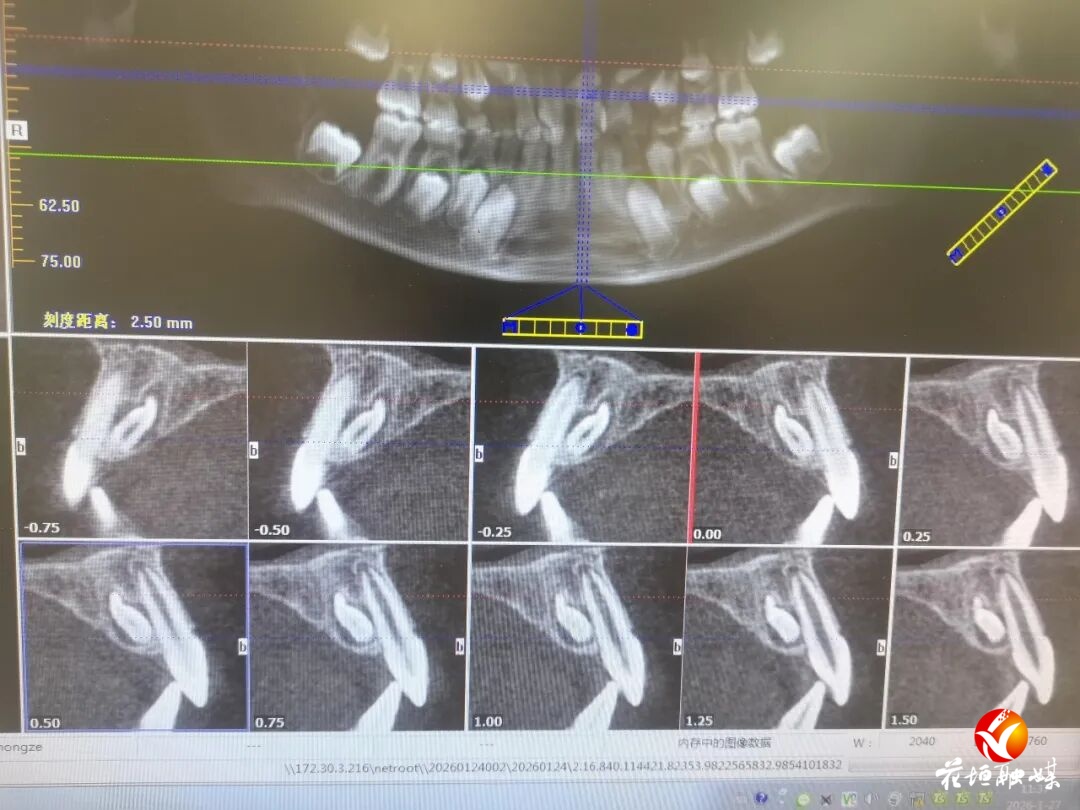 巧手除“埋伏”！花垣县人民医院口腔科为9岁儿童微创拔除高难度多生牙